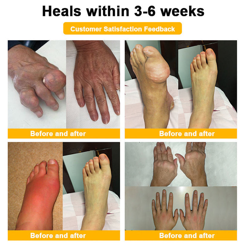 【Last Day Promotion 80% OFF🔥】FDA Official: LBMLBM™ BeeVenom Joint Relief Patch – Arthritis Pain Relief, Anti-Inflammation & Mobility Support(Zero Pain | 24/7 Comfort | Natural Healing)🔥🎁