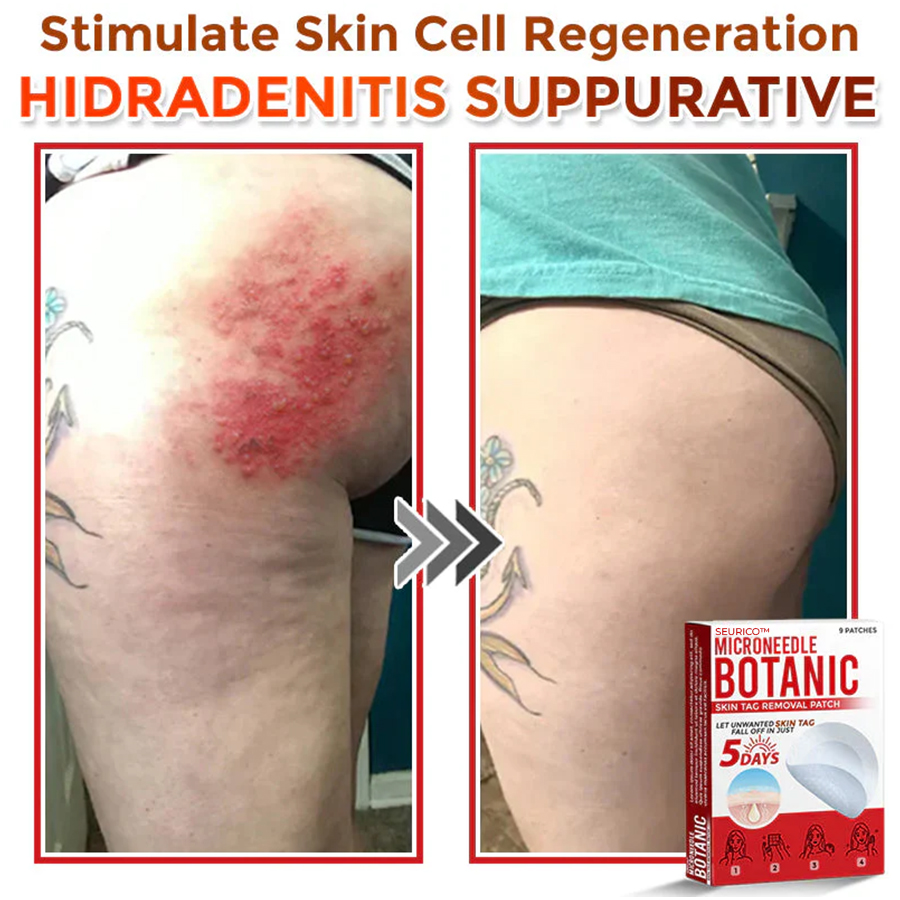 Seurico™ MicroNeedle Botanic Skin Tag Removal Patch