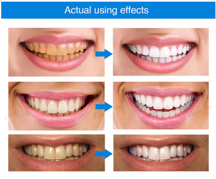 Instant Bright Teeth Whitening Essence Pen – Gentle & Sensitivity-Free (Copy)