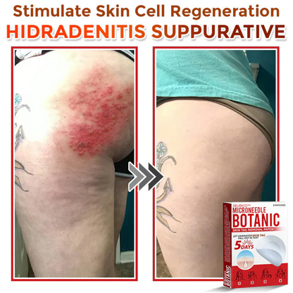 Seurico™ MicroNeedle Botanic Skin Tag Removal Patch