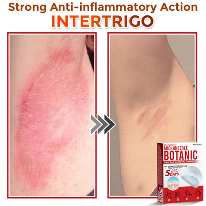 Seurico™ MicroNeedle Botanic Skin Tag Removal Patch