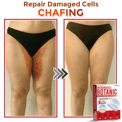 Seurico™ MicroNeedle Botanic Skin Tag Removal Patch