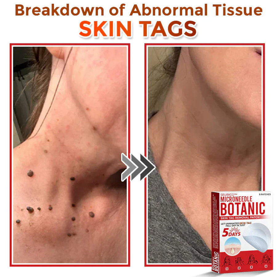 Seurico™ MicroNeedle Botanic Skin Tag Removal Patch