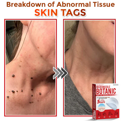 Seurico™ MicroNeedle Botanic Skin Tag Removal Patch