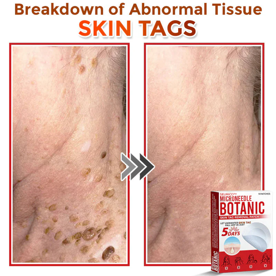 Seurico™ MicroNeedle Botanic Skin Tag Removal Patch