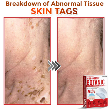Seurico™ MicroNeedle Botanic Skin Tag Removal Patch
