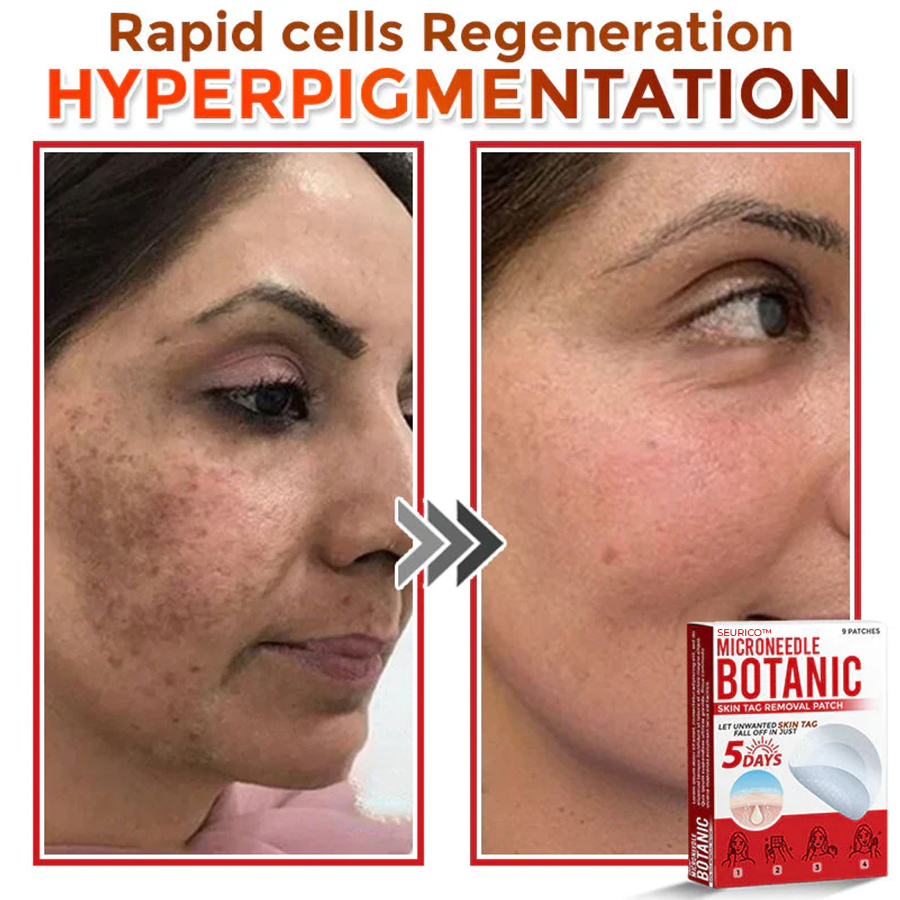 Seurico™ MicroNeedle Botanic Skin Tag Removal Patch