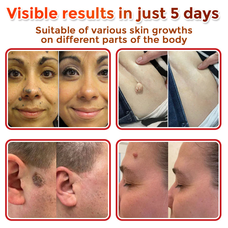 Seurico™ MicroNeedle Botanic Skin Tag Removal Patch