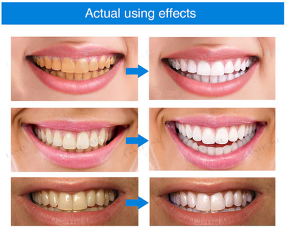 Instant Bright Teeth Whitening Essence Pen – Gentle & Sensitivity-Free (Copy)